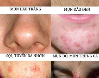 6 loại mụn thường gặp