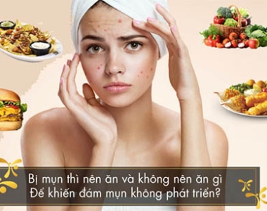 Da mụn kiêng ăn gì? Top 5 loại đồ ăn nên tránh khi bị mụn